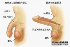 西宁勃起障碍常见误区